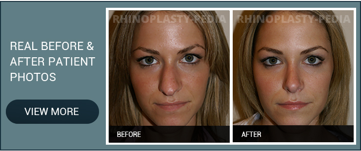 rhinoplasty consultation in New York female patient before and after photo
