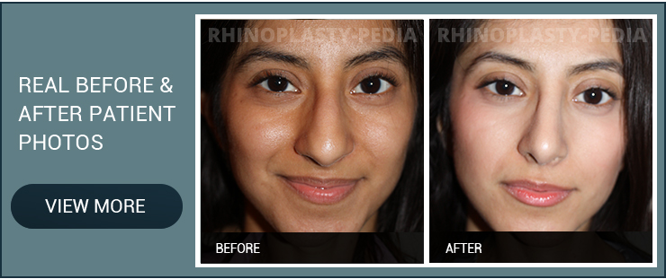 before a rhinoplasty patient before and after photo