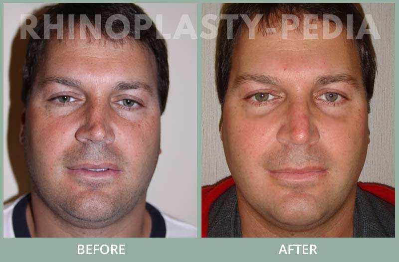rhinoplasty male patient before and after photo 18