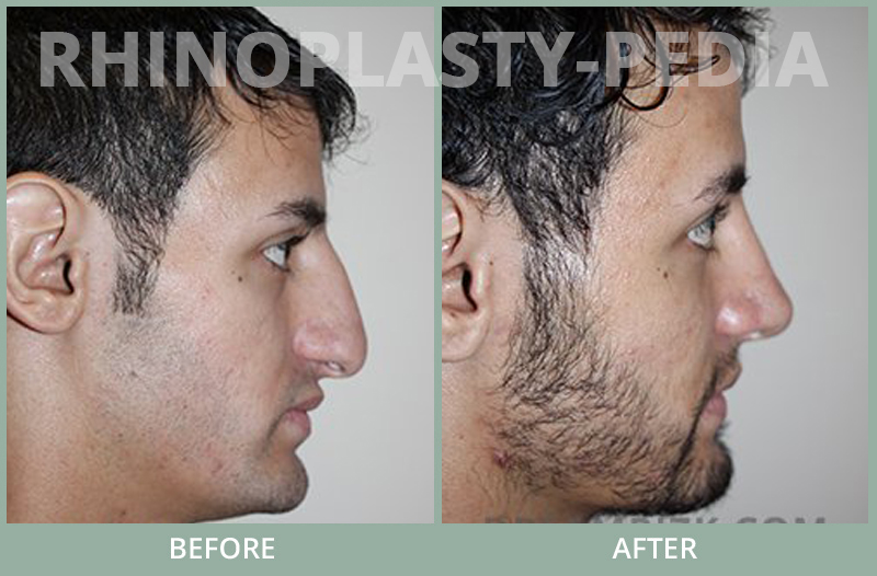 rhinoplasty female patient before and after photo set 61