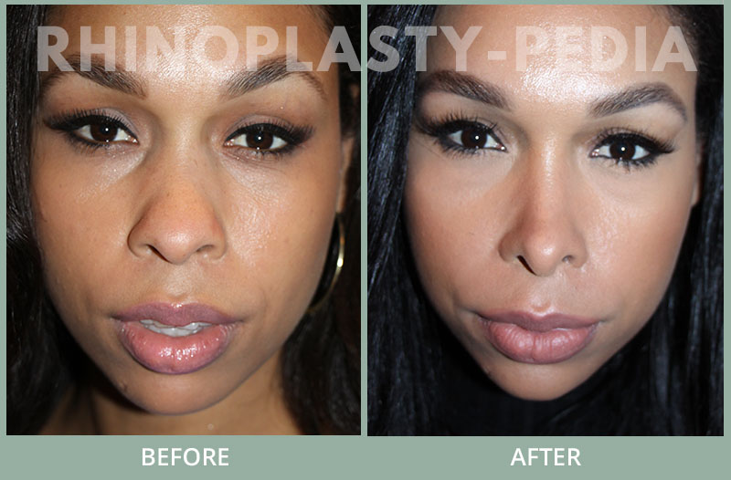 rhinoplasty female patient before and after photo set 68