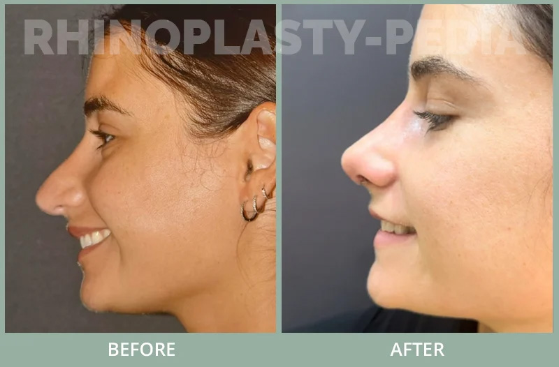 This patient is shown only I week after revision rhinoplasty / septoplasty with MTF rib bank cartilage to correct pollybeak deformity , hanging tip , collapse of right internal and external nasal valve and caudal septal deviation to the right . Her breathing and cosmetic appearance are improved post-surgery.