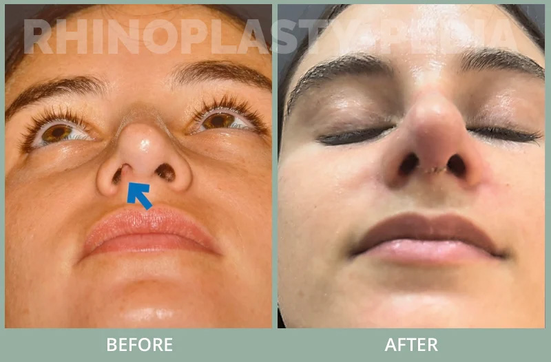 This patient is shown only I week after revision rhinoplasty / septoplasty with MTF rib bank cartilage to correct pollybeak deformity , hanging tip , collapse of right internal and external nasal valve and caudal septal deviation to the right . Her breathing and cosmetic appearance are improved post-surgery.